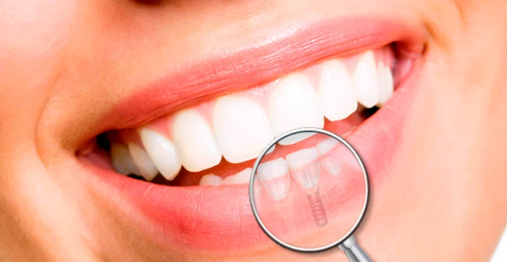 Dentiste Haguenau 67500 Extraction et implantation immédiate