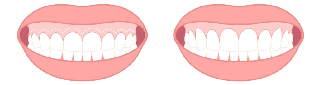 Gingivectomie Dentiste Haguenau 67500