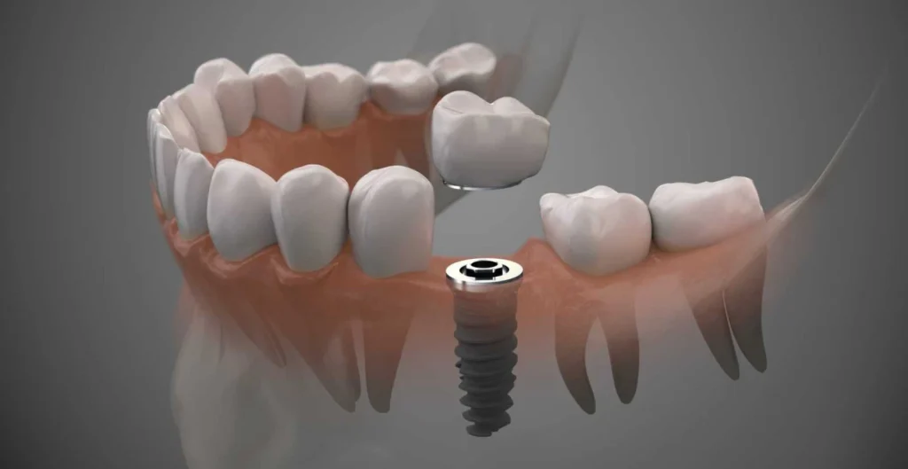 Implant dentaire Dentiste Haguenau 67500