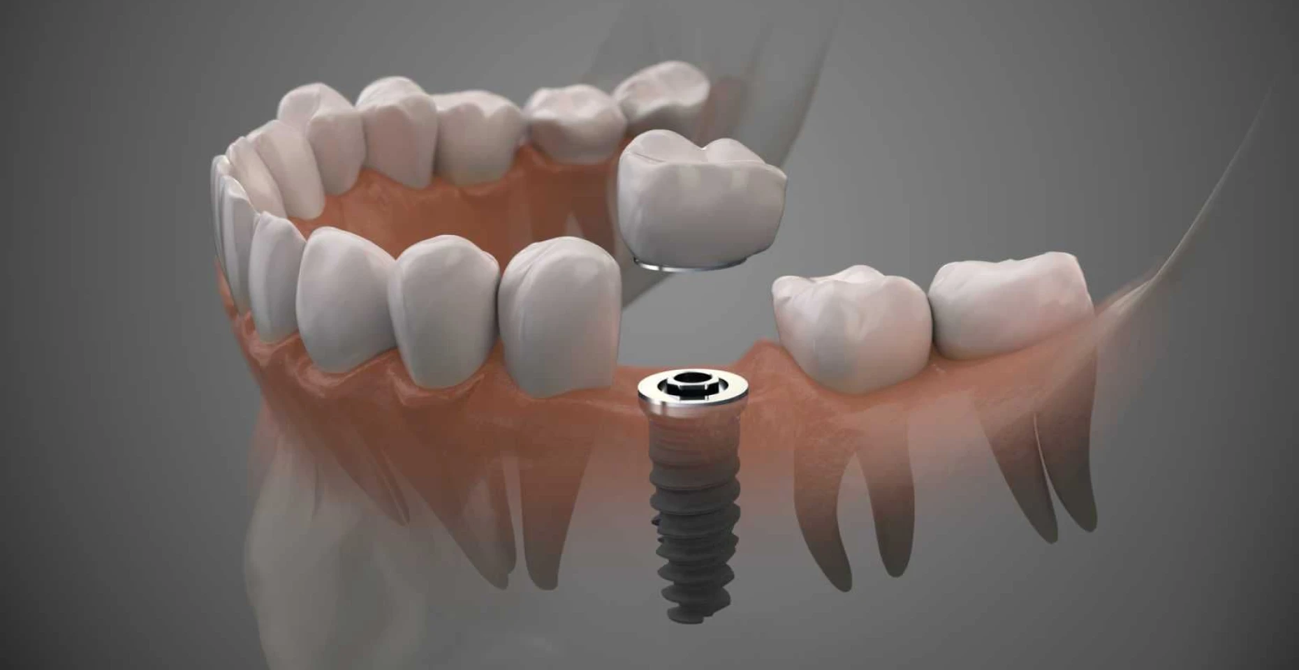 Implant unitaire posé par le Dr Nicolas Cocco à Haguenau