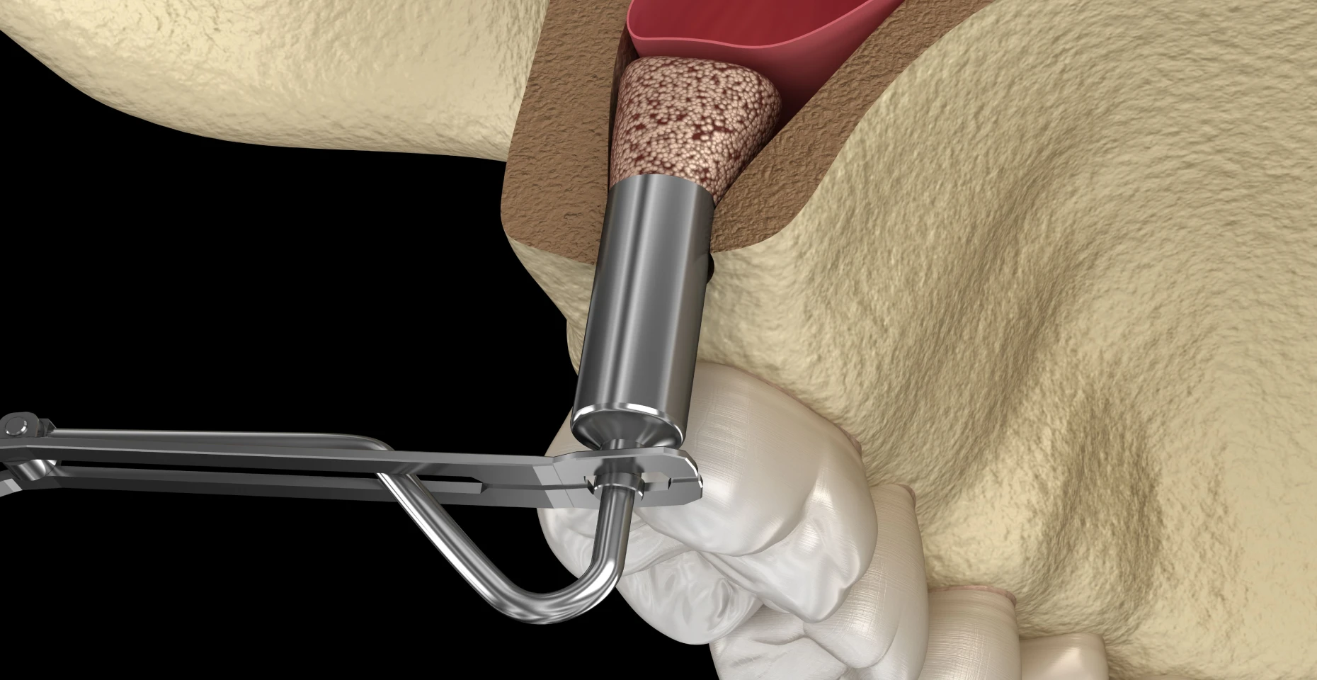 Sinus lift effectué avant pose d’implants dentaires à Haguenau