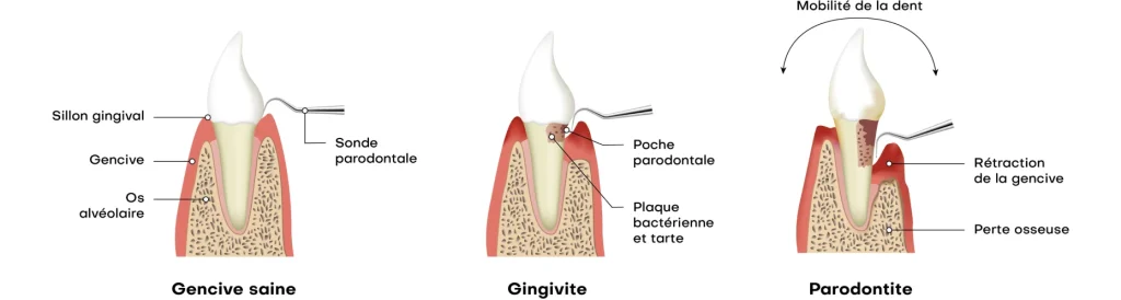 Dentiste Haguenau 67500 Soin de gencives